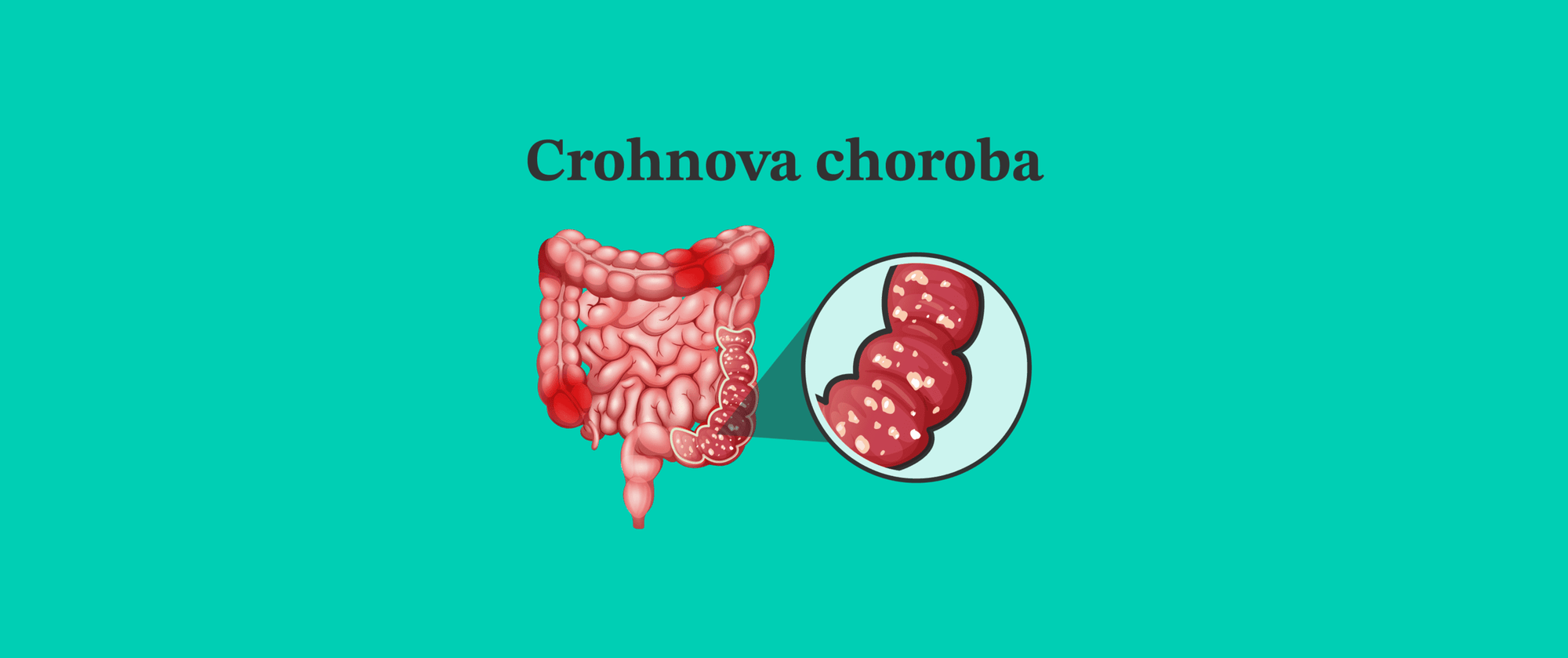 Crohnova choroba - chronické ochorenie, ktoré sa nedá úplne vyliečiť