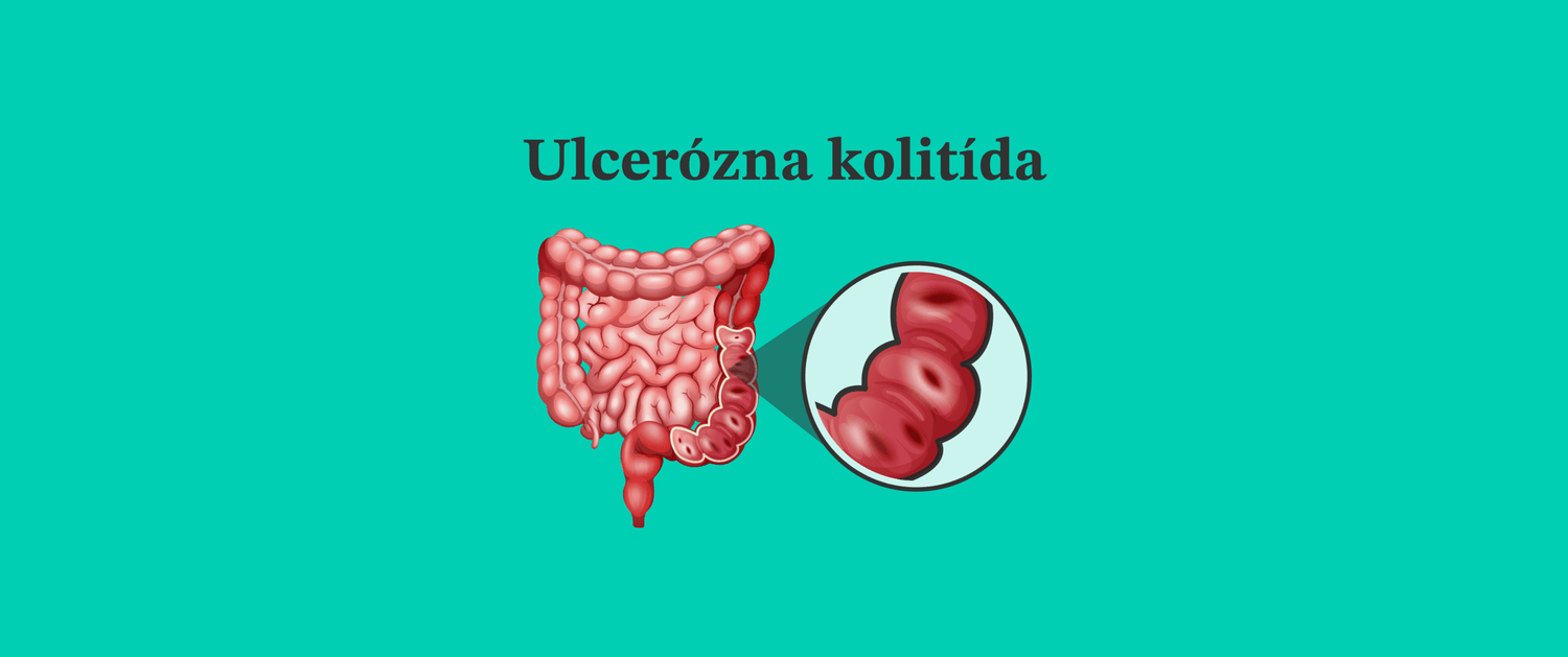 Ulcerózna kolitída - čo to je, príznaky, diagnostika a liečba